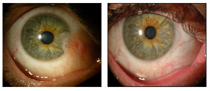 pterygium before after